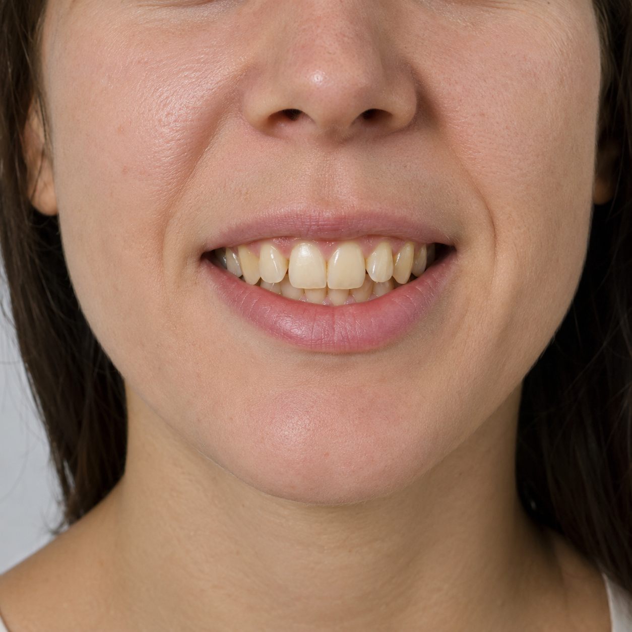 Lamina veneer öncesi ve sonrası örnek görsel — öncesi