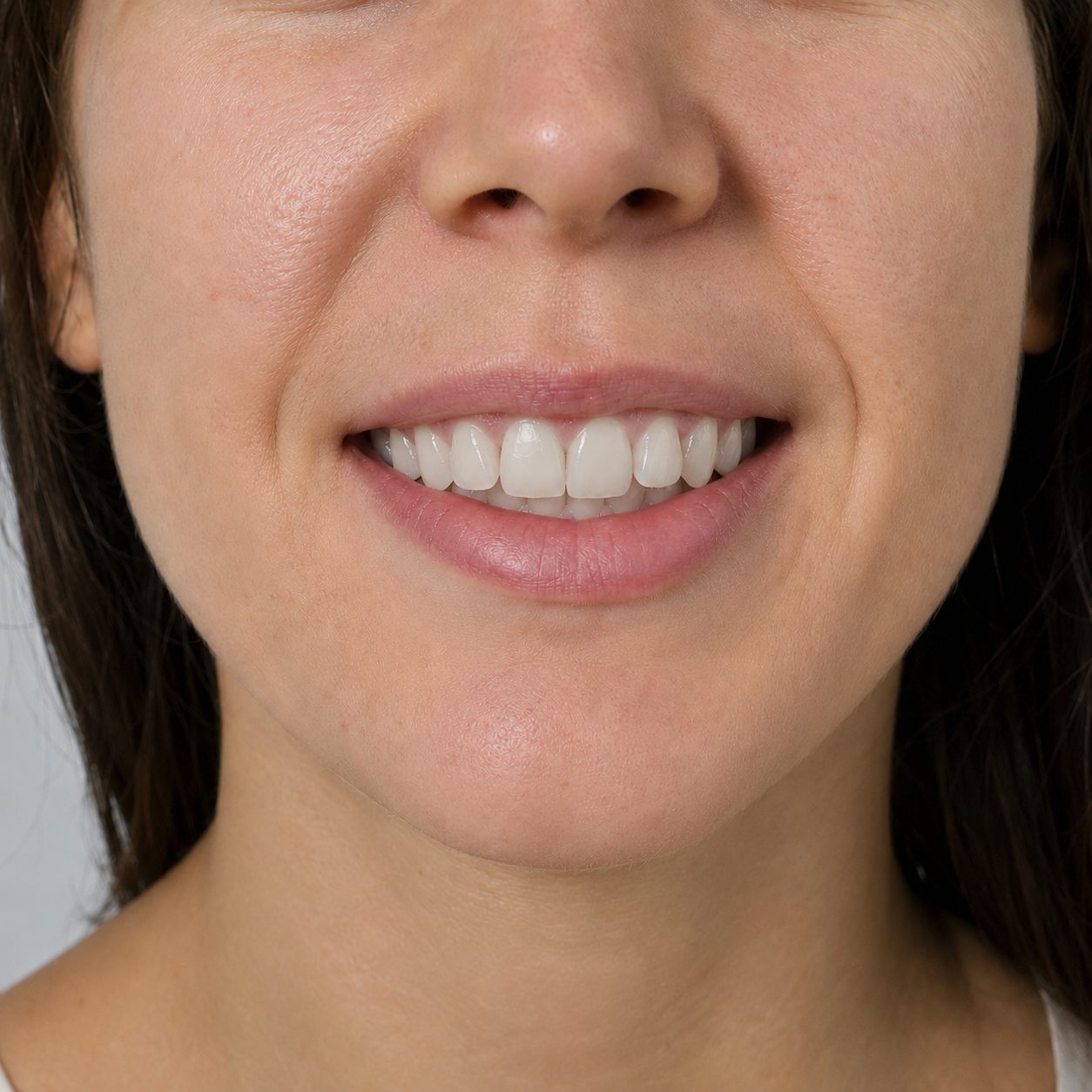 Lamina veneer öncesi ve sonrası örnek görsel — sonrası
